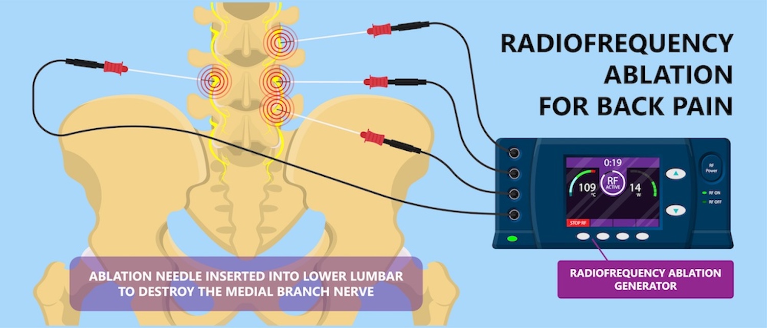 is-radiofrequency-ablation-painful