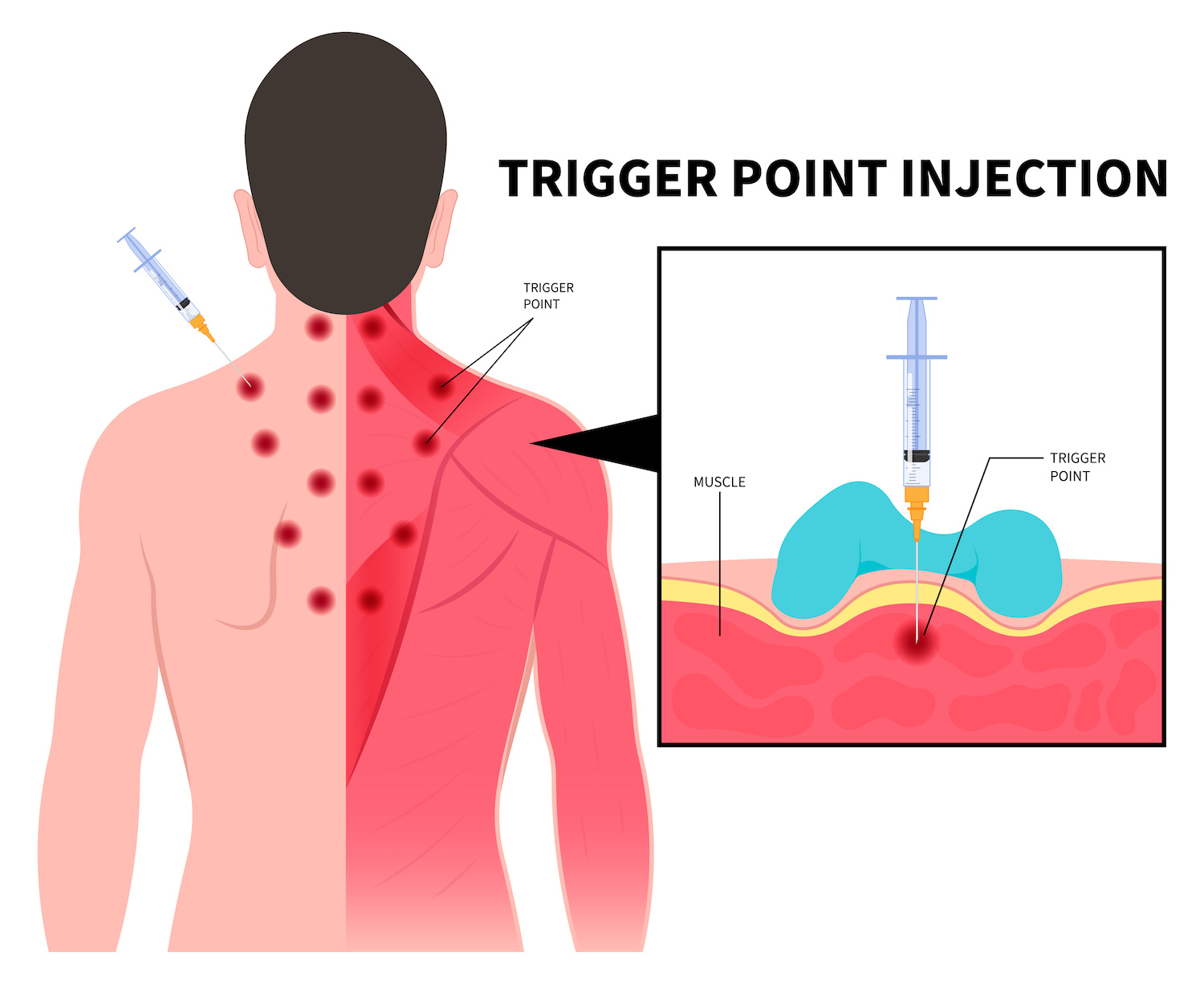 trigger-point-injections-for-muscle-pain-are-they-worth-it